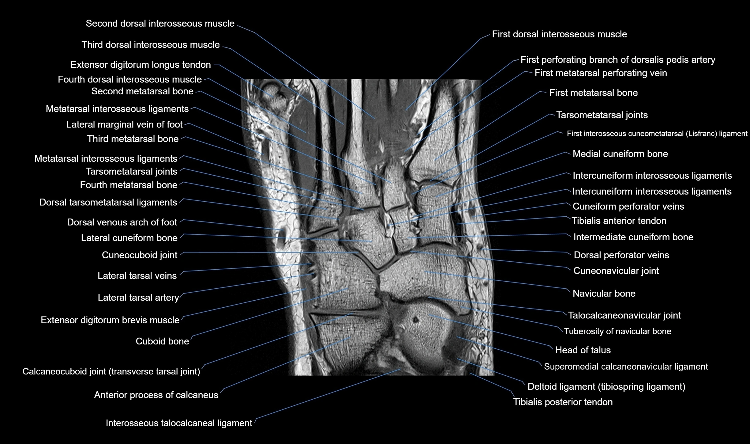 MRI mid foot coronal ligaments cross sectional anatomy 3T  radiology  image-img-00001-00021.webp